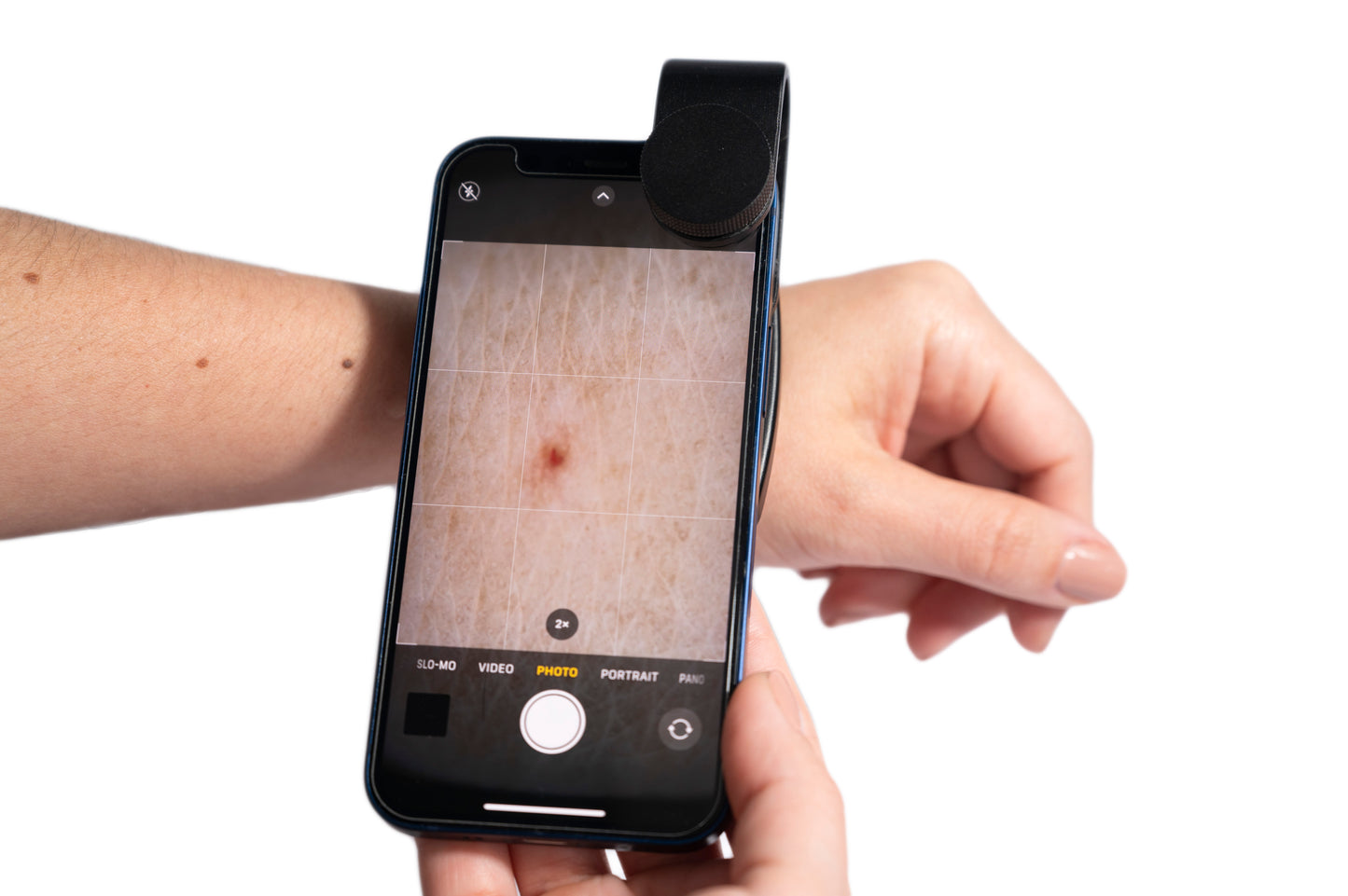 VITEYE BUNDLE: Dermascope smartphone attachment + App
